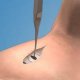 Surgical Cricothyrotomy